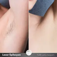 eniyilazer1