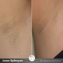 eniyilazer2