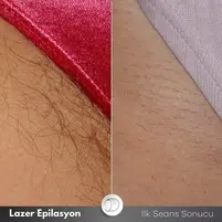 eniyilazer3